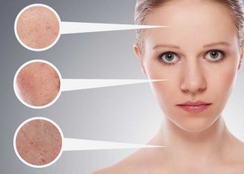 Dùng BHA bị đẩy mụn phải làm sao? Có nên nặn không?