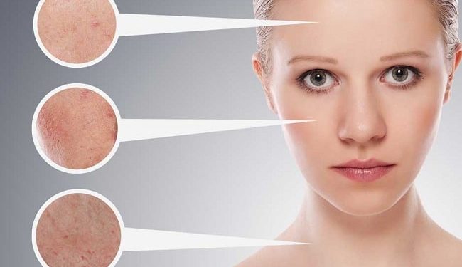 Dùng BHA bị đẩy mụn phải làm sao? Có nên nặn không?