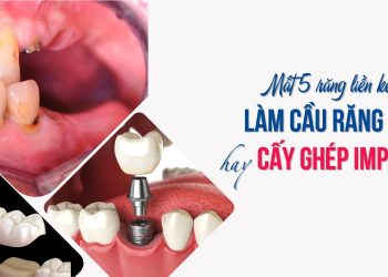 Mất 5 răng liền kề: Làm cầu răng sứ hay cấy ghép Implant?