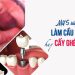Mất 5 răng liền kề: Làm cầu răng sứ hay cấy ghép Implant?