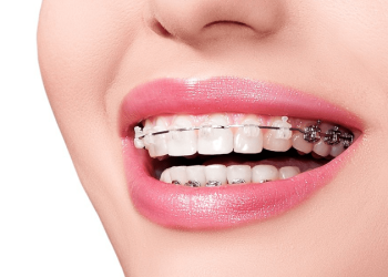 Niềng răng có tốt không? Sự thật bạn cần biết?