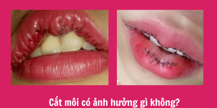 Cắt môi có ảnh hưởng gì không? Hậu quả nên cân nhắc